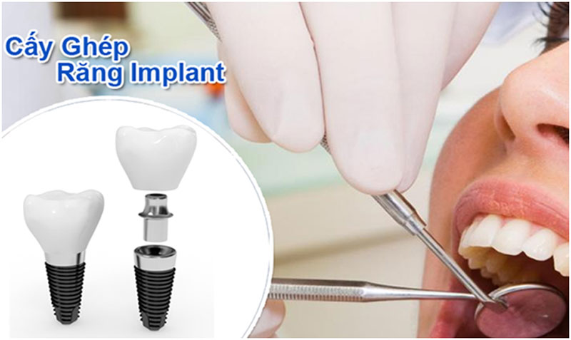 Cấy ghép răng Implant – Xu hướng phục hồi răng ưu việt nhất hiện nay